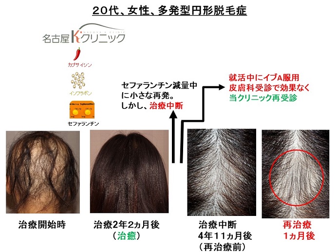 円形脱毛症　病院